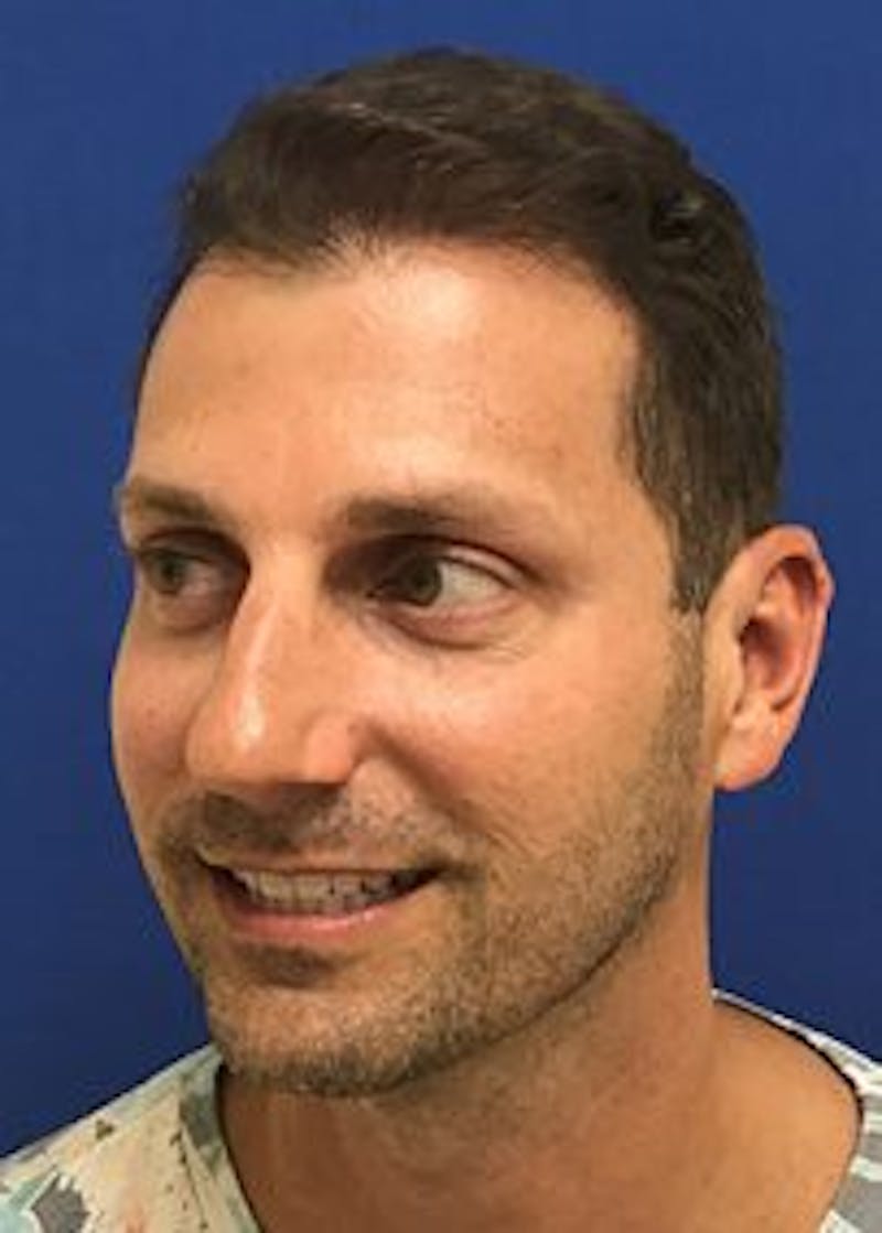Male Surgical Gallery Before & After Gallery - Patient 166658377 - Image 8