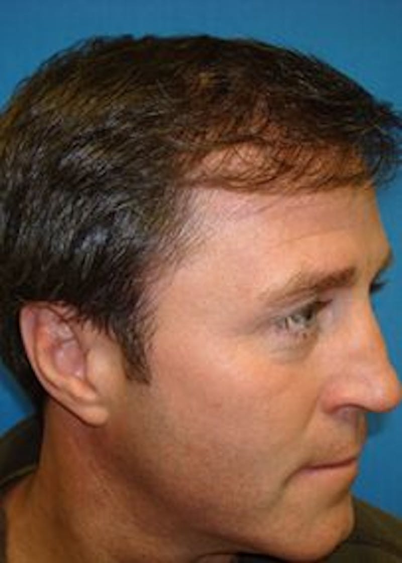 Male Surgical Gallery Before & After Gallery - Patient 166658398 - Image 4