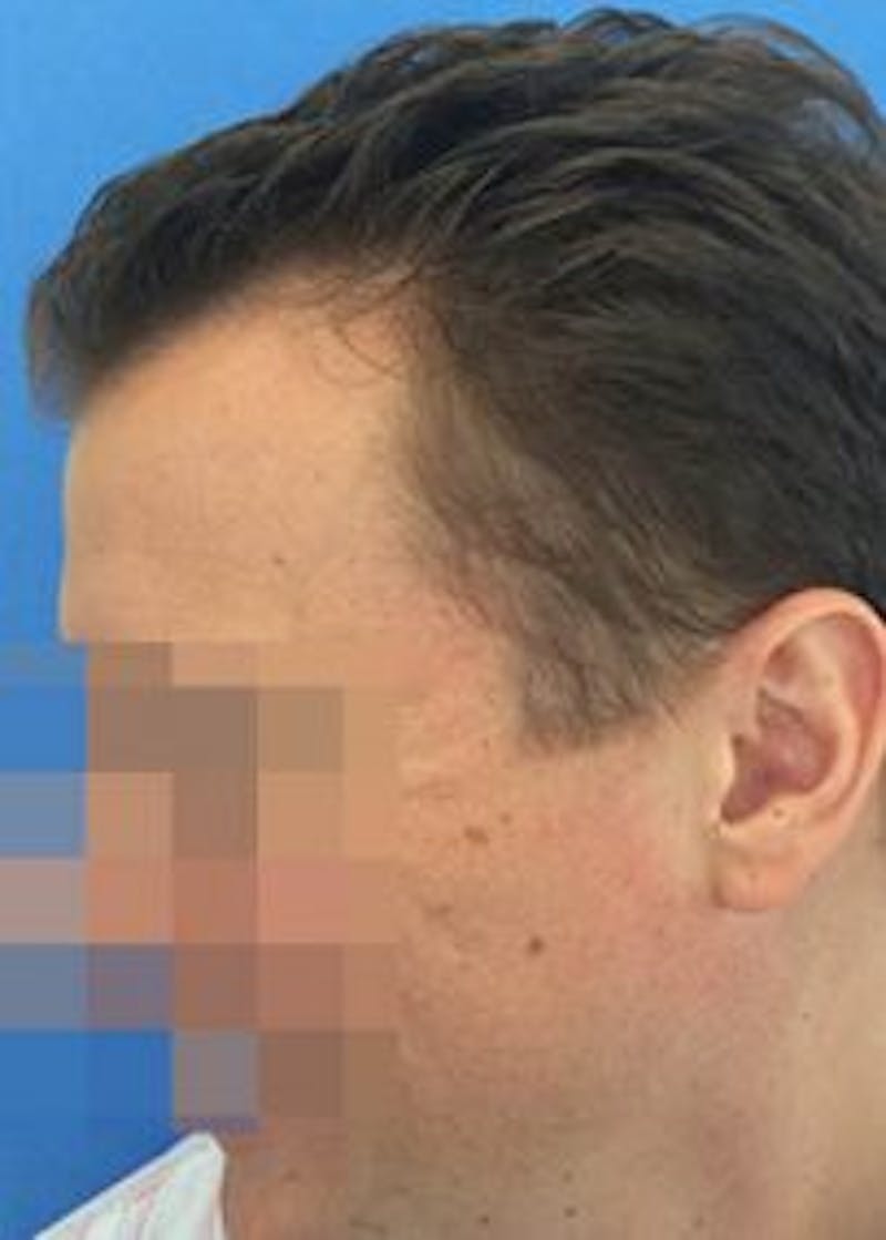 Male Surgical Gallery Before & After Gallery - Patient 166658437 - Image 3