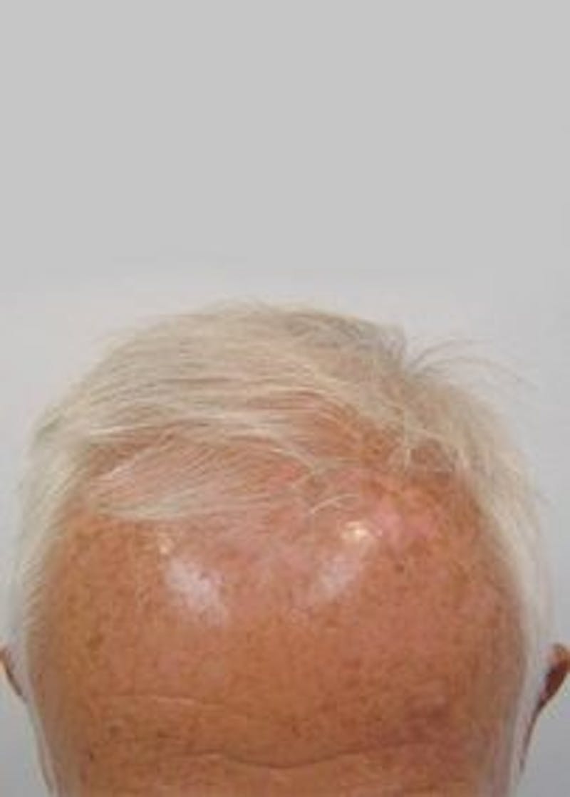 Male Surgical Gallery Before & After Gallery - Patient 166658487 - Image 3