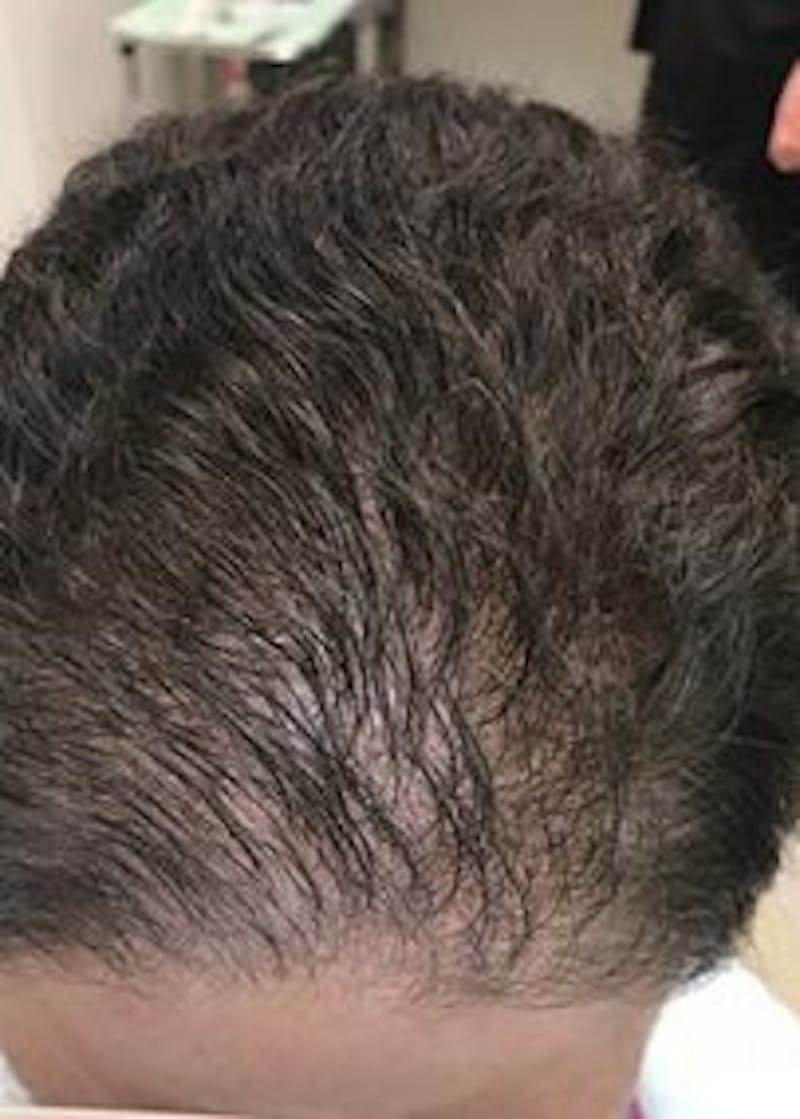 Non-Surgical Gallery Before & After Gallery - Patient 166658838 - Image 1
