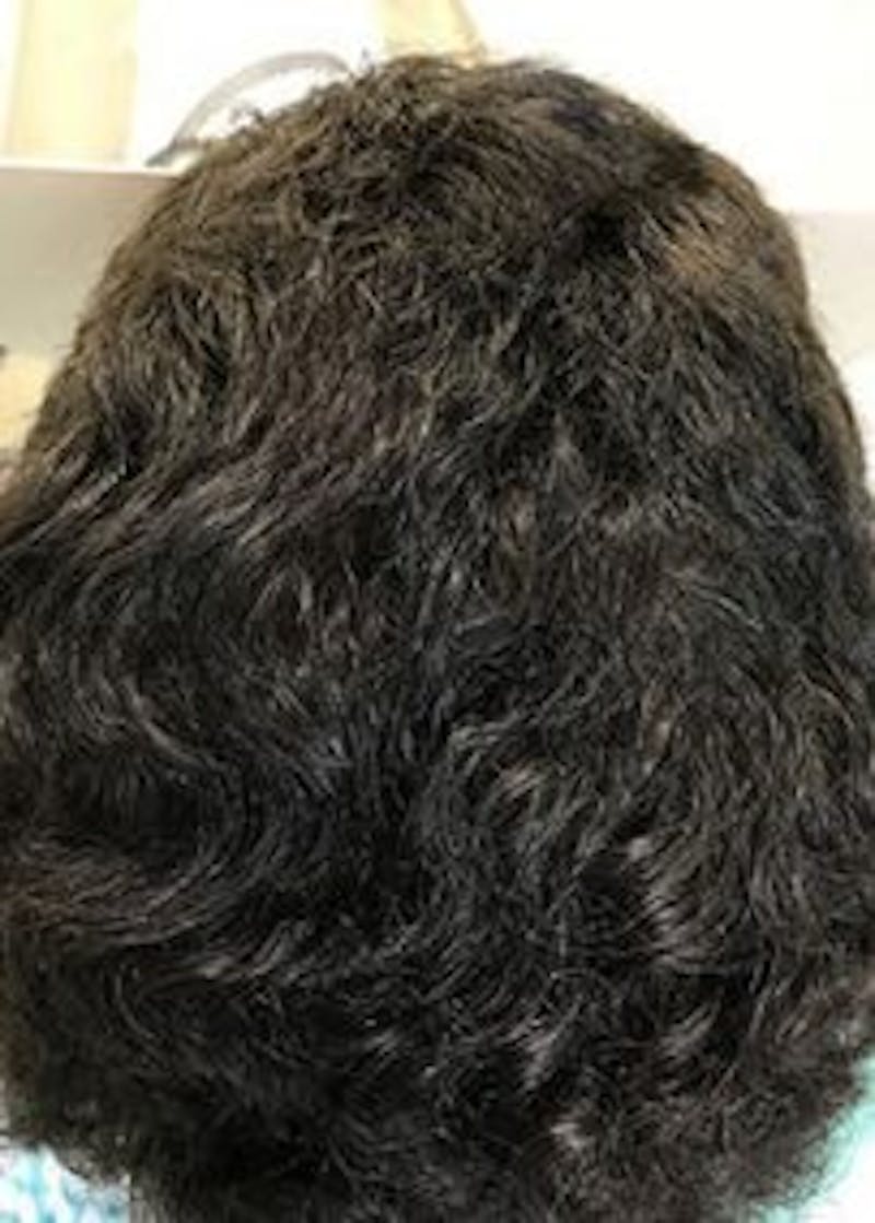 Non-Surgical Gallery Before & After Gallery - Patient 166658838 - Image 4