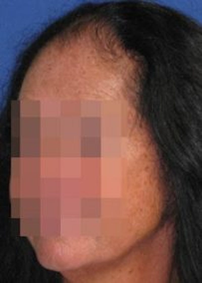 Female Surgical Gallery Before & After Gallery - Patient 166658856 - Image 3