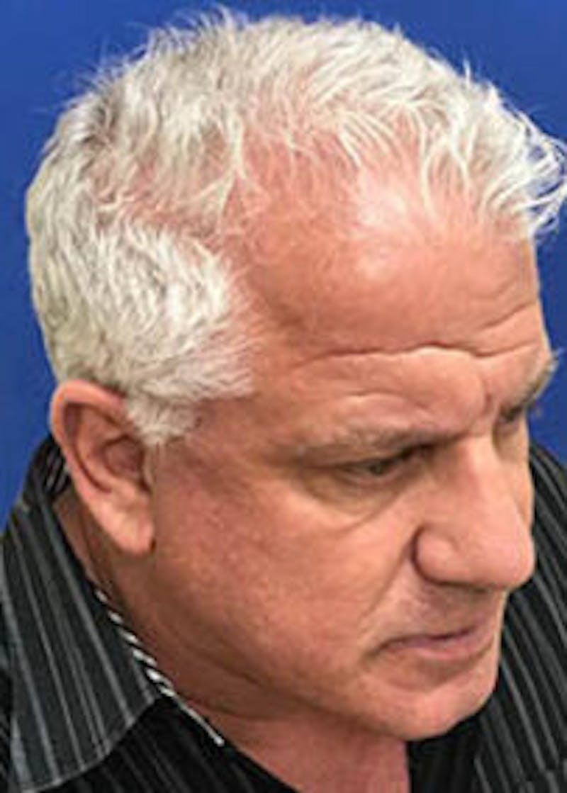 Non-Surgical Gallery Before & After Gallery - Patient 179737922 - Image 7