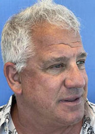 Non-Surgical Gallery Before & After Gallery - Patient 179737922 - Image 8