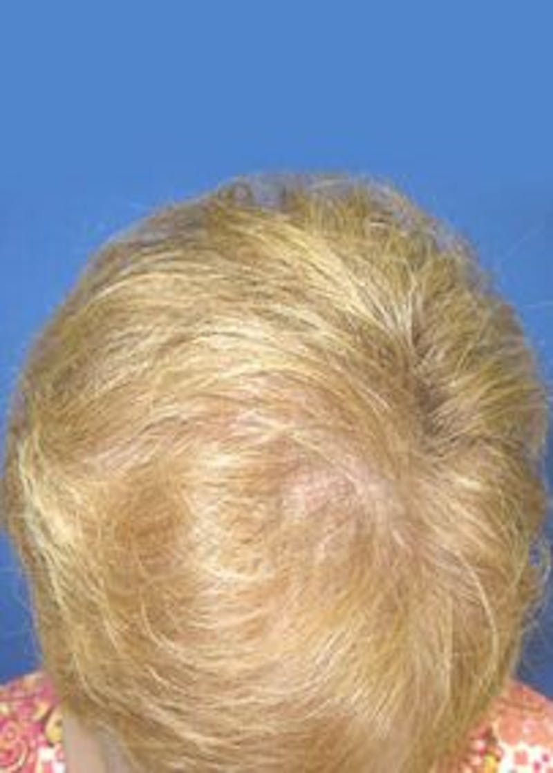 Non-Surgical Gallery Before & After Gallery - Patient 166658928 - Image 4