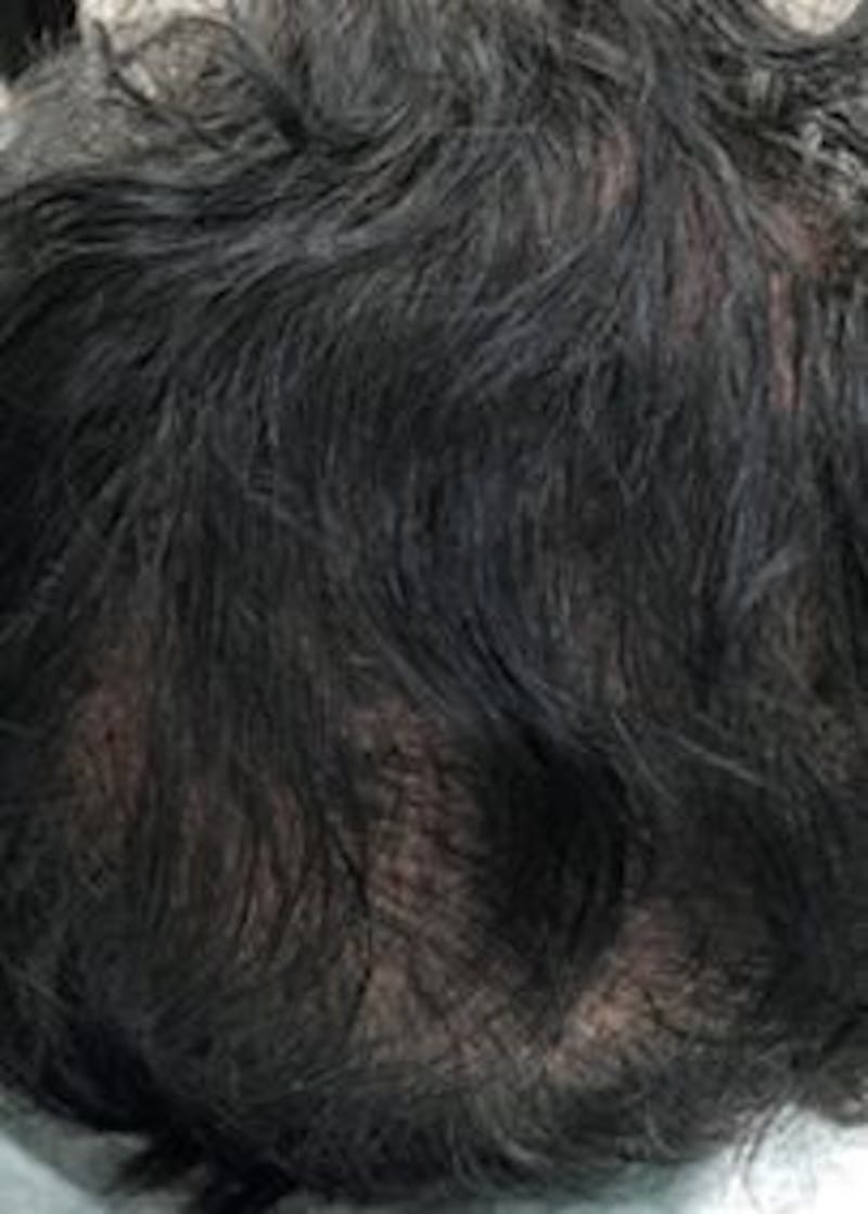 Non-Surgical Gallery Before & After Gallery - Patient 166658931 - Image 4