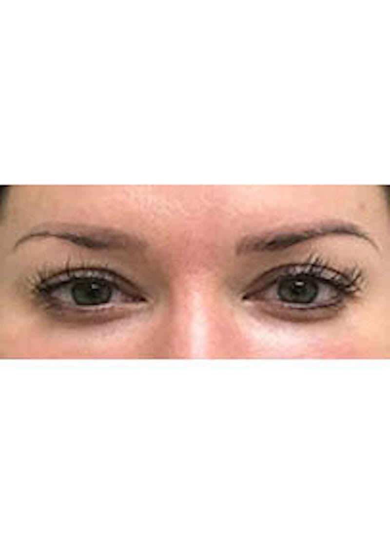 Female Surgical Gallery Before & After Gallery - Patient 166658932 - Image 1