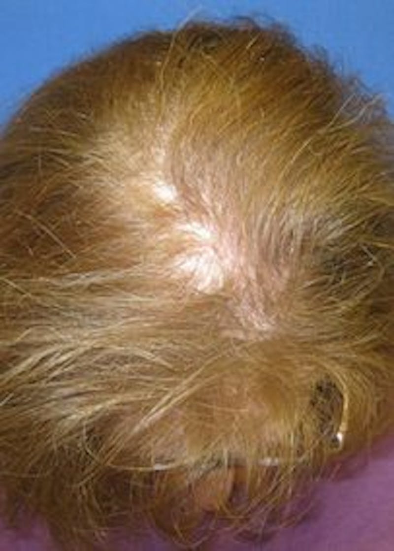 Non-Surgical Gallery Before & After Gallery - Patient 166658933 - Image 3