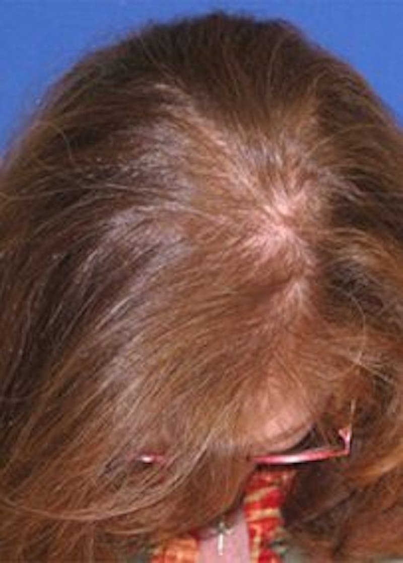 Non-Surgical Gallery Before & After Gallery - Patient 166658933 - Image 4