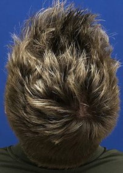 Non-Surgical Gallery Before & After Gallery - Patient 166658936 - Image 2