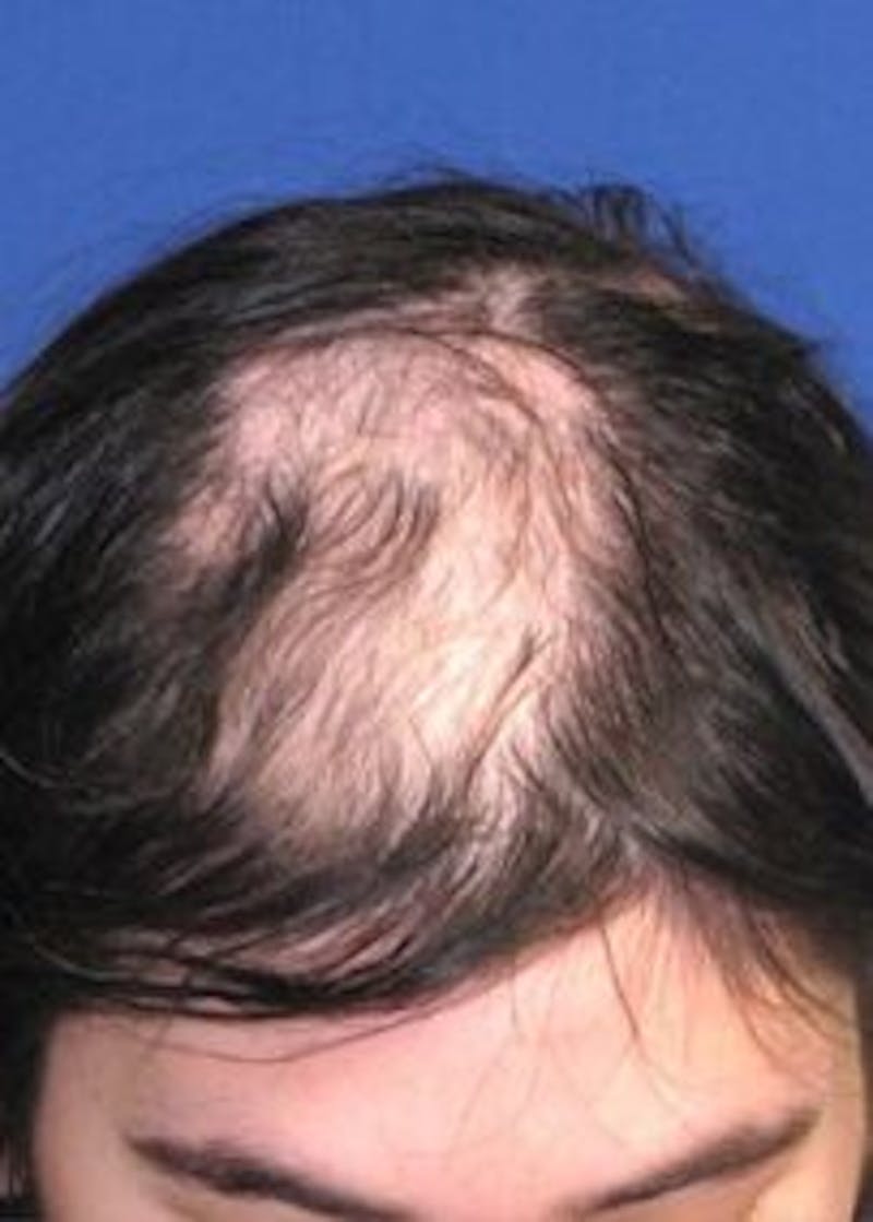 Non-Surgical Gallery Before & After Gallery - Patient 179731301 - Image 3