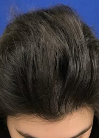 Non-Surgical Gallery Before & After Gallery - Patient 179731301 - Image 4