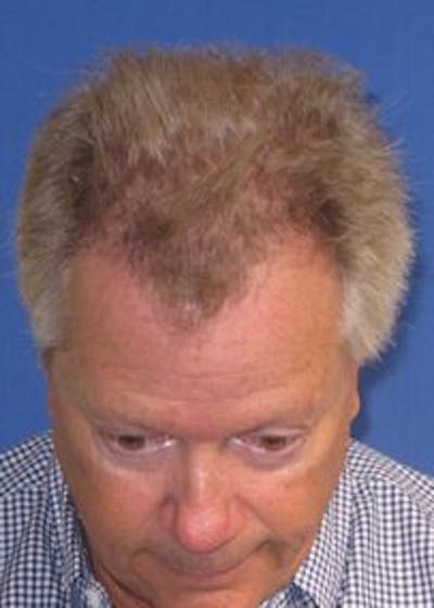 Non-Surgical Gallery Before & After Gallery - Patient 166658941 - Image 1