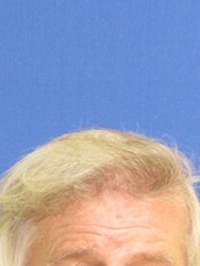 Non-Surgical Gallery Before & After Gallery - Patient 166658943 - Image 1