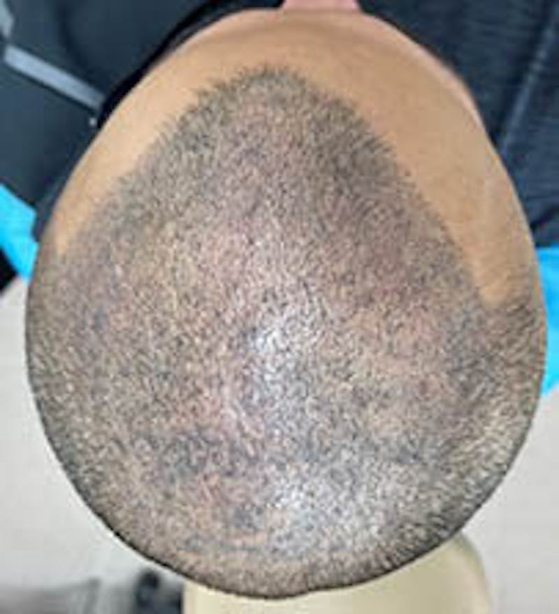 Non-Surgical Gallery Before & After Gallery - Patient 166658948 - Image 4