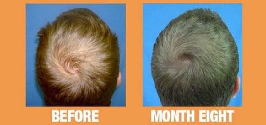 Reversing Male Pattern Baldness Greco Hair Restoration