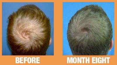 Reversing Male Pattern Baldness