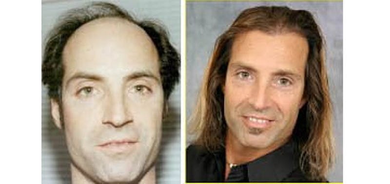 before and after of a man who was balding and now has hair