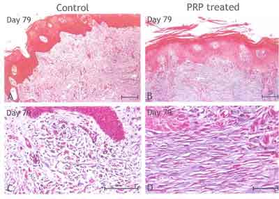 Benefits of PRP in Donor Sites