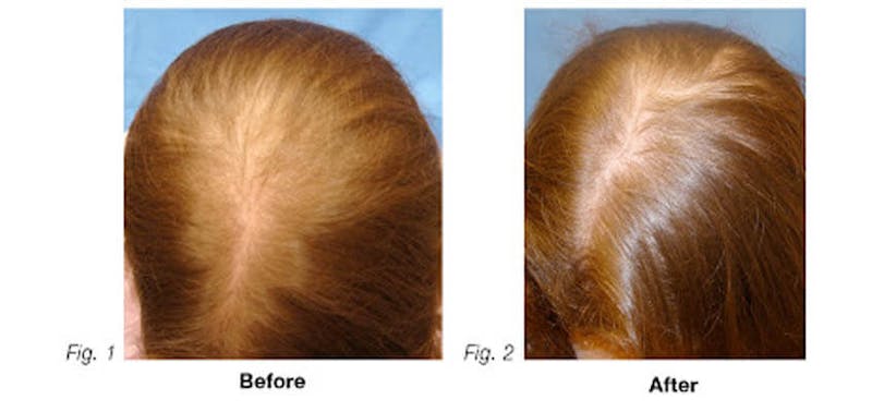 woman's before and after picture of hair restoration