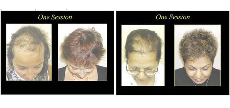picture of before and after hair restoration