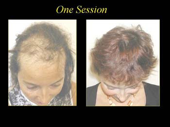 before and after hair restoration