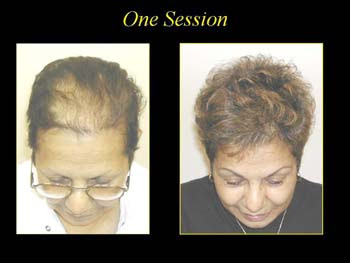 before and after picture of hair transplant