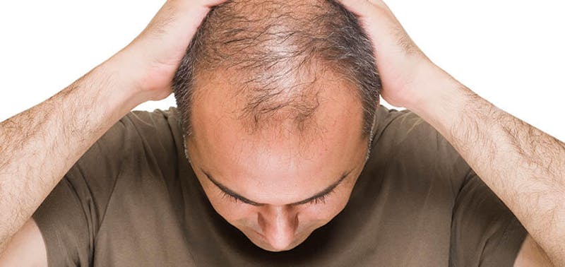 picture of a man's balding head