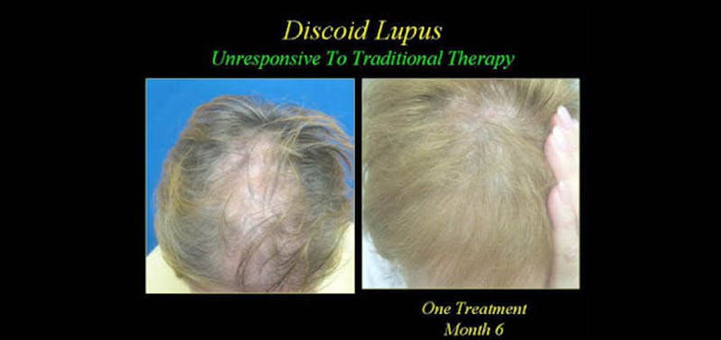 before and after of hair restoration