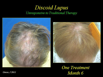 PRP Treatment and Lupus Patients