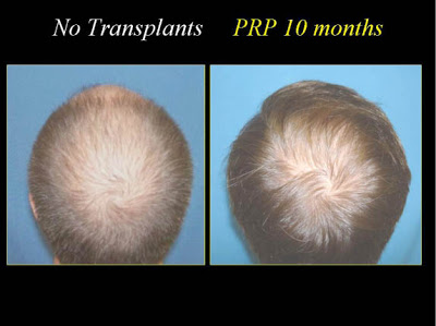 Extra Cellular Matrix (ECM) and PRP w