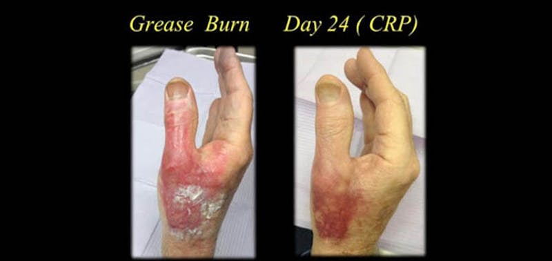 picture of a burned hand