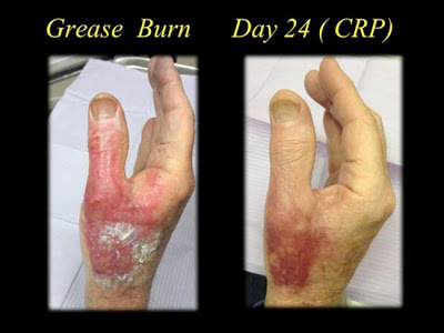 picture of a grease burn