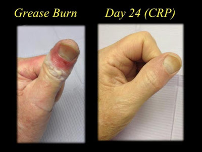 picture of a grease burn