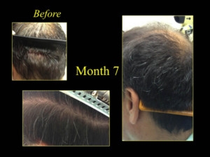 before and after of hair restoration