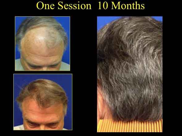 before and after hair restoration