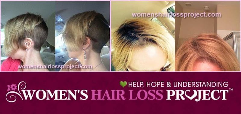 Picture of hair restoration