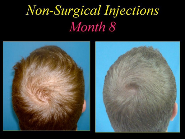 before and after photos of hair restoration