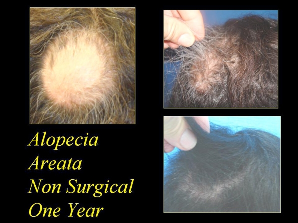 before and after photos of hair restoration