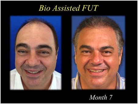 before and after photo of hair restoration