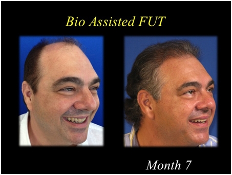 before and after photo of hair restoration