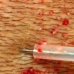 needle going into the skin