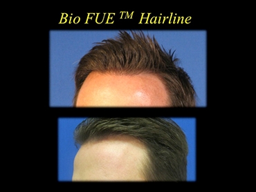 hairline before and after