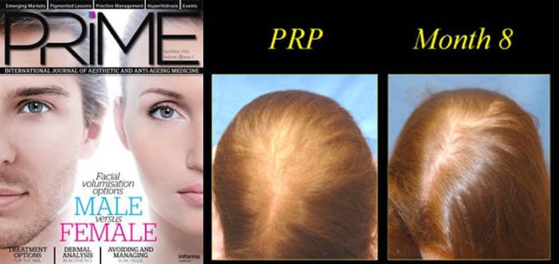 PRP before and after