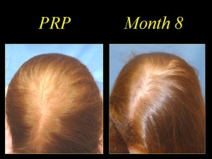 PRP before and after 