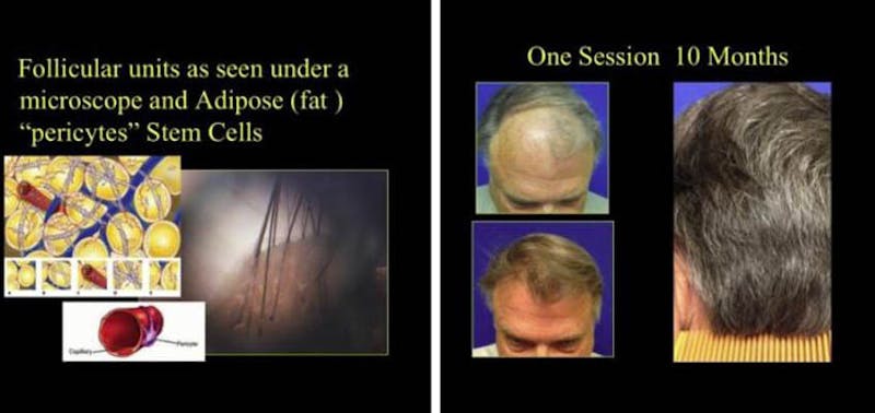 Picture of hair restoration