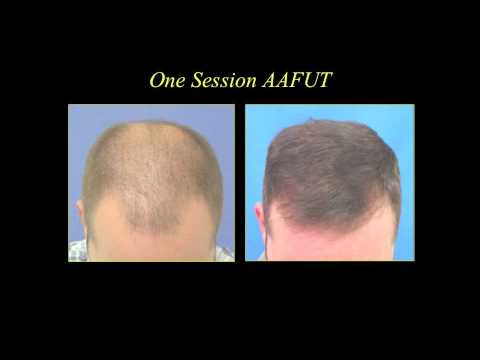 hair restoration before and after