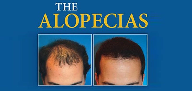 Alopecia before and after hair restoration