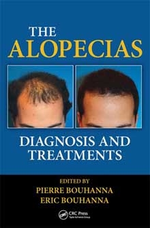 Alopecia before and after hair restoration